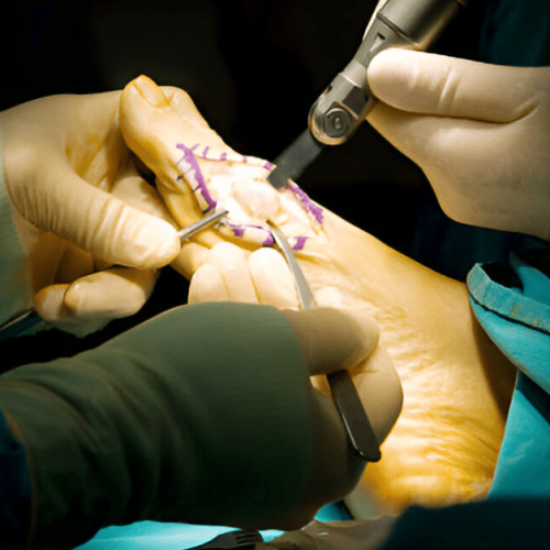 What Is Bunionectomy with Osteotomy Sole Foot and Ankle Sole Foot Doc foot doctor in Podiatrist Valparaiso IN