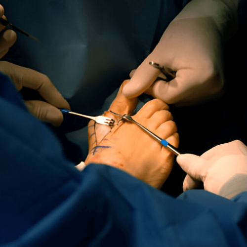 What Kind Of Foot Surgery Are There Sole Foot and Ankle Sole Foot Doc Podiatrist Valparaiso IN